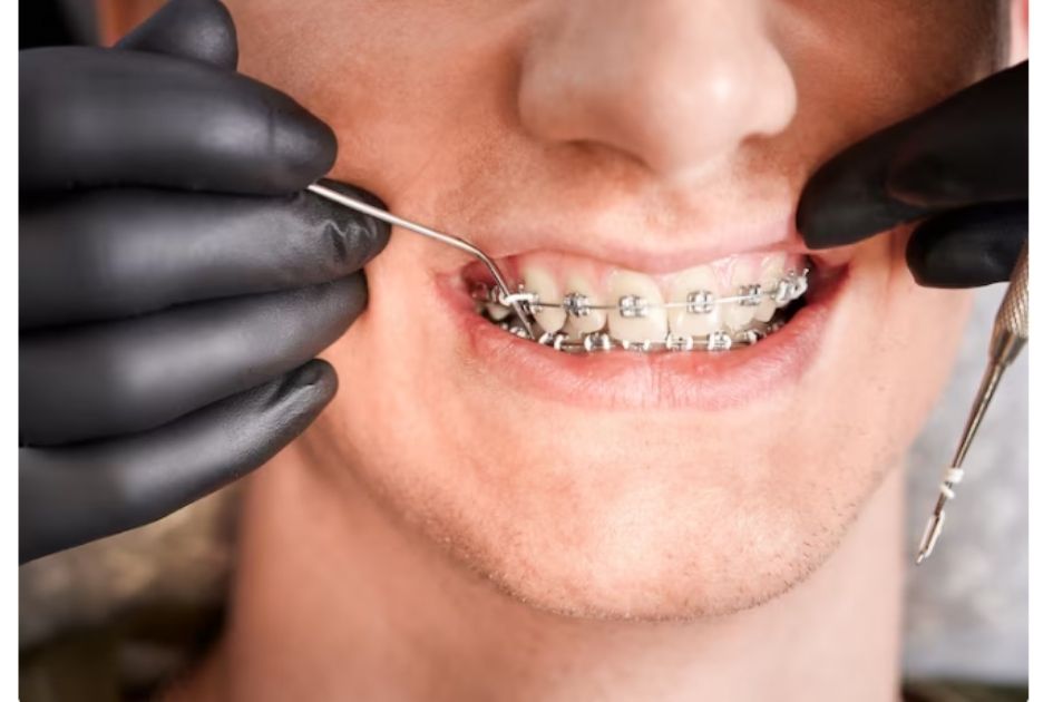 metal braces cost in mumbai